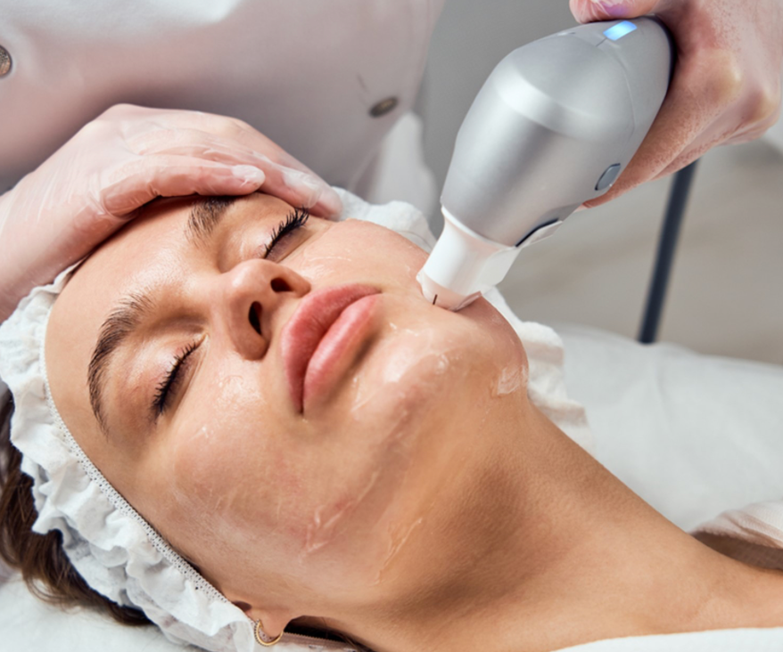 Ultraformer MPT Naso-Labial Folds (Smile Lines)
