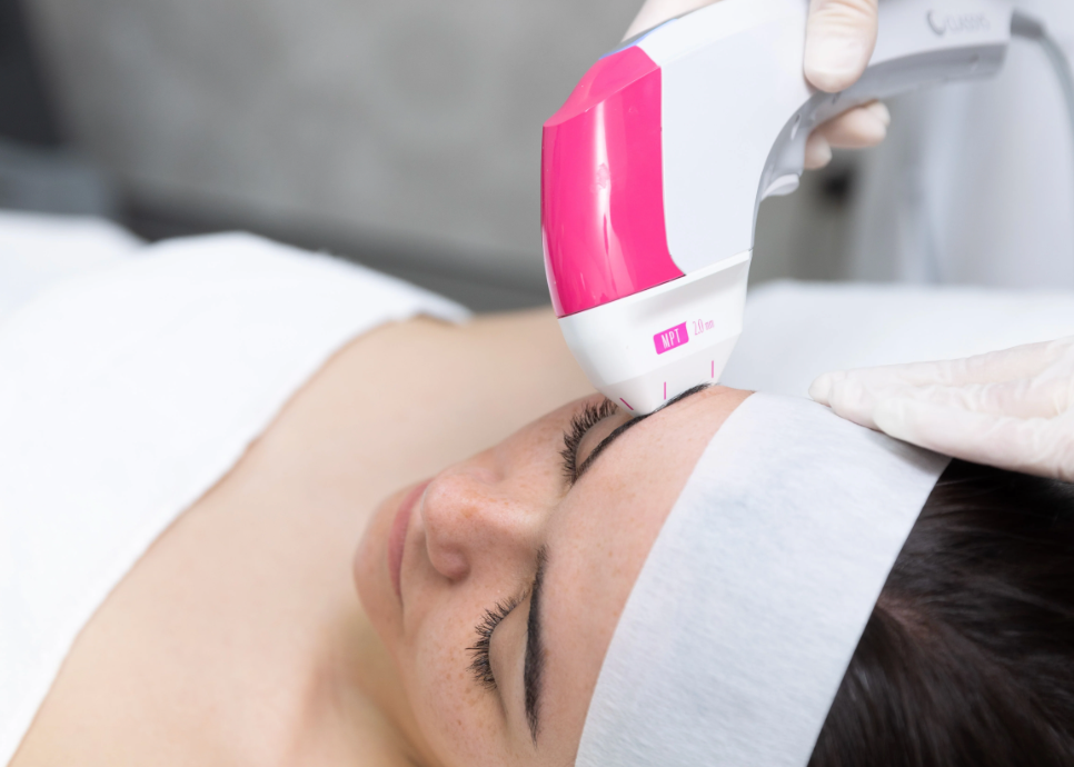 Ultraformer  MPT Crows Feet/ Under Eyes