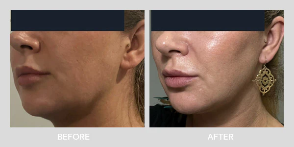 Ultraformer MPT Chin Lift &amp; Tighten